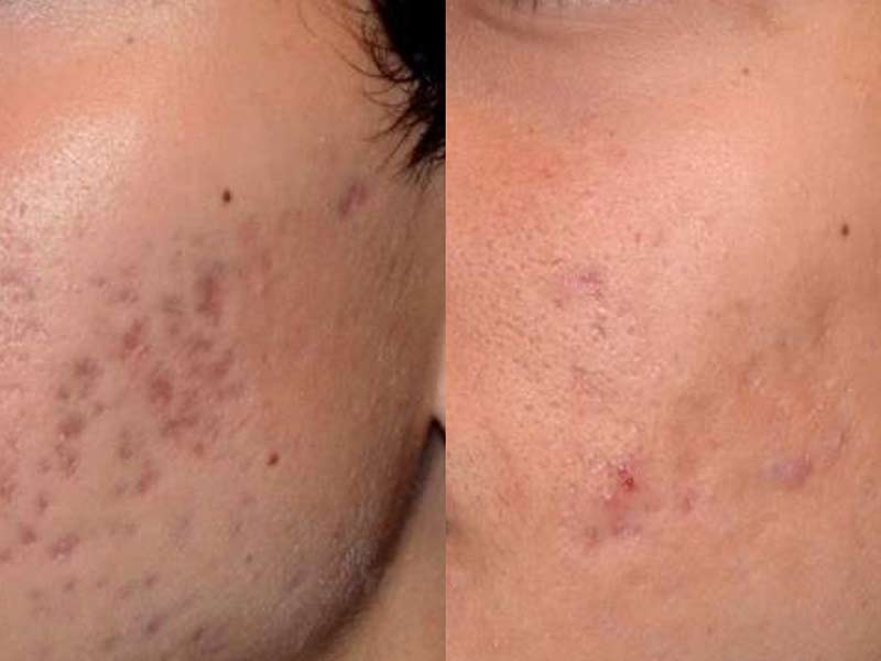 acne littekens in het gezicht