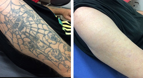 Politie Vergoeding staart Tattoo verwijderen | Ervaringen | het Lasercentrum